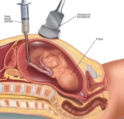 Fetal Reduction