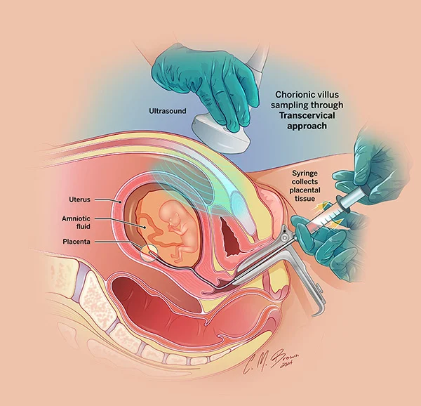CVS (Chorionic villi sampling)