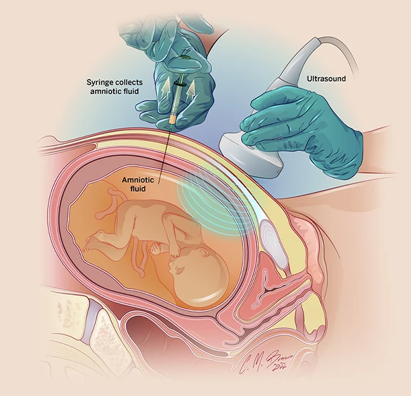 Amniocentesis