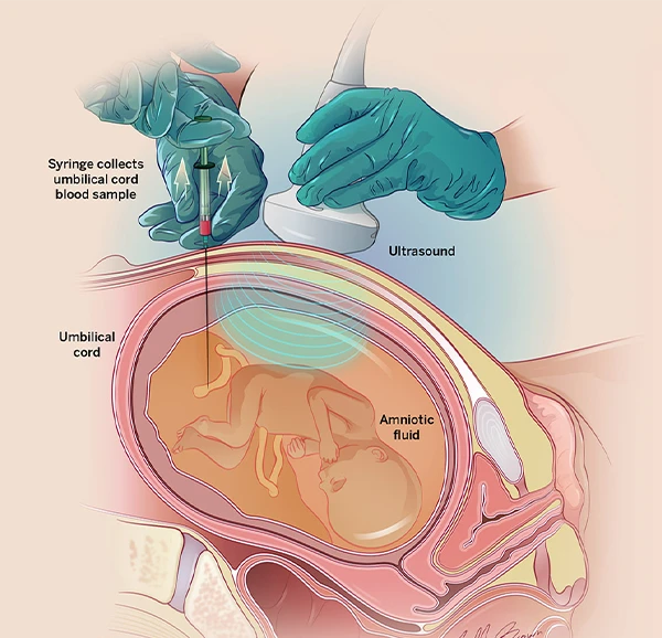 Fetal Blood Transfusion
