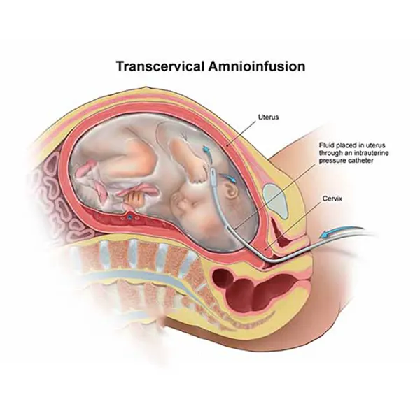 Amnioinfusion