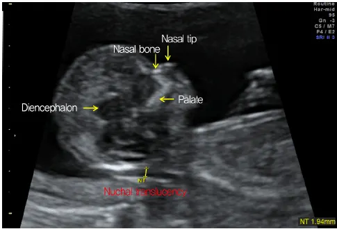 NT Scan (Nuchal Translucency Scan)