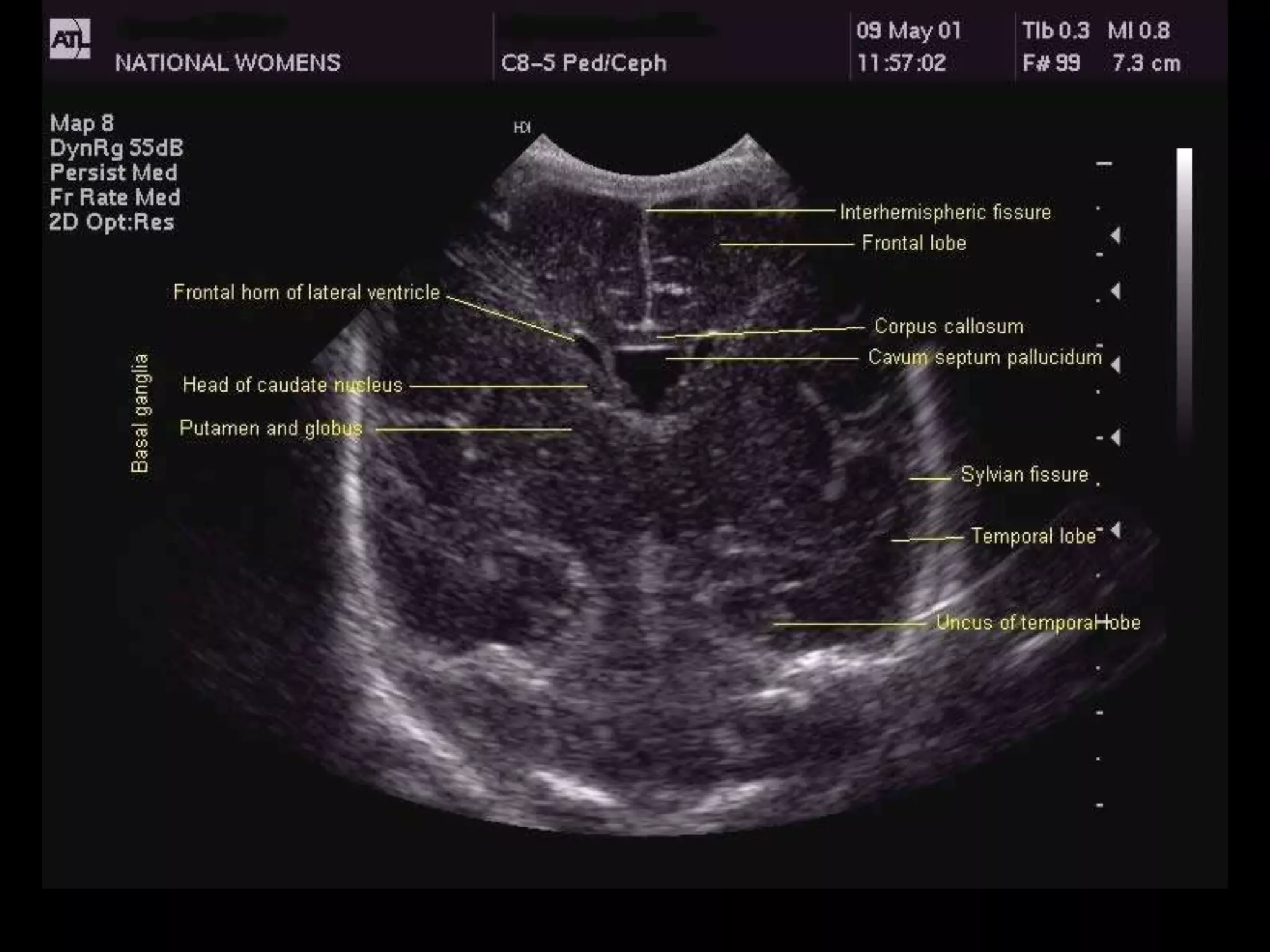 Neurosonogram